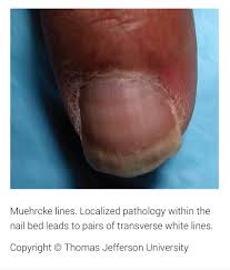 Image result for Muehrcke Line