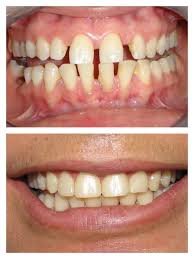 Full Mouth Diastema Closure