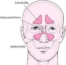 Bei einer akuten nasennebenhöhlenentzündung sollte ein antibiotikum, sofern es gut wirkt, die krankheitsdauer im mittel um 2 bis 3 tage verkürzen. Nasennebenhohlenentzundung Hals Nasen Und Ohrenerkrankungen Msd Manual Ausgabe Fur Patienten