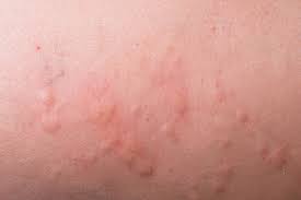 3 research shows that, you may start experiencing the rash in as soon as 4 hours after exposure. Should We Label Patients With A Sulfa Allergy Lesson Learned The Hard Way Med Ed 101