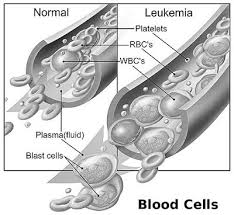 This is the most common type of leukemia in children. Signs And Symptoms Of Childhood Leukemia Acco