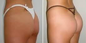 Découvrez le prix du lipofilling fessier avec un chirurgien esthétique à paris 8 et 16. Lipofilling Fesses Tunisie Injection Graisse Fesses Prix Sur 36 Mois