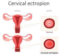 Cervical Ectropion Health Navigator Nz
