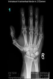 Knochenbruche An Hand Und Fingern Obere Extremitat Hand Und Mikrochirurgie Immanuel Krankenhaus Berlin