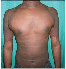 Image result for Diffuse Hyperpigmentation