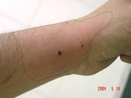 Image result for Cat Bite