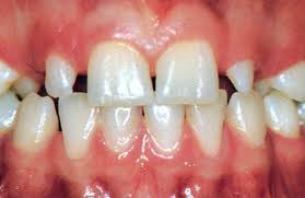 Bonjour voilà, hier en plein service j'ai ma dent de devant qui à commencer à me faire mal, je pensé à une petite miette de pain coincé, mais ça à empire, et je. Anomalies Des Dents Definitives Bucco