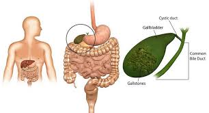 Alami Pengobatan Batu Empedu Selain Operasi Gallbladder Gallbladder Attack Relief Gallbladder Attack