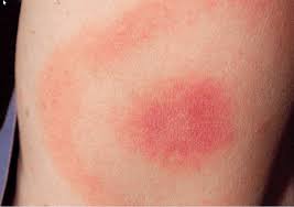 Shooting pains, numbness, or tingling in the hands or feet. Maladie De Lyme Le Chu Centre De Competence Chu Amiens Picardie