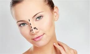 Rinoplastia