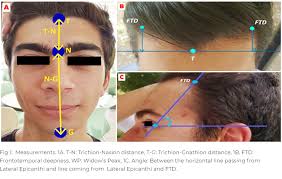 Receding hairline in men is a continuous process of hair loss that frequently starts from the forehead. Receding Hairline Hairline Experts Hlc Hairline Clinic