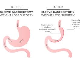 gastric sleeve in turkey weight loss