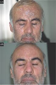 Full article: Treatment of traumatic tattoo with the Q‐switched Nd:YAG laser