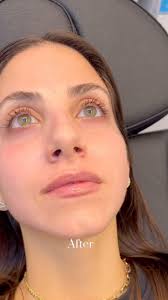 Lip Filler💉👄, This was her first time getting lip filler! She wanted a  natural and hydrated look! We also worked