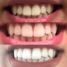 Find the right teeth whitening kit that fits your budget and needs. Drop Everything Because Crest Whitestrips Are Luckily On Sale For Prime Day