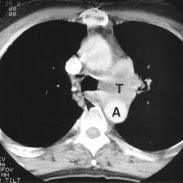 A tumor site located in the lung tissue or subpleural: Chest Ct Scan Showing A Central Left Sided Lung Cancer With Suspected Download Scientific Diagram