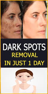 Dark Spots Removal In Just 1 Day Dark Spots On Face Remove Dark Spots Skin Care Dark Spots