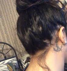 2010, but my hair loss continues. Had A Scalp Biopsy Done And The Diagnosis Was Diffuse Alopecia Areata Not Completely Bald Circular Spots More So Diffusely Around My Scalp This Is My Hair In A Bun I M On