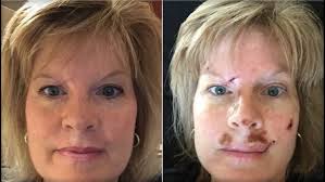 Woman shares graphic images to spread skin cancer warning