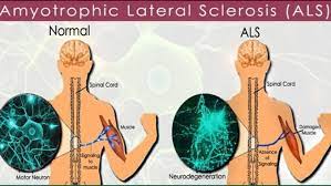 La esclerosis lateral amiotrófica (ela) se conoce también como enfermedad de lou gehrig. Esclerosis Lateral Amiotrofica Elacyl