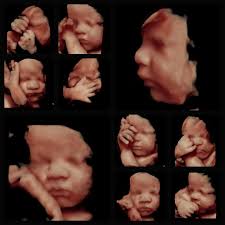 This little 35 week baby put up a good fight trying to hide behind those  hands! 🥹