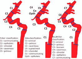 Içá river, also known as the putumayo river. Classifi Cation Of Ica Segments According To Fisher Gibo Bouthillier Download Scientific Diagram
