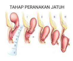 Dalam dunia medis, peranakan turun kerap diistilahkan dengan prolaps uteri. Urut Tradisional Nusajaya Jb Tak Elok Angkat Barang Berat Nanti Peranakan Jatuh Seringkali Kita Mendengar Pesanan Orang Tua Bahawa Wanita Perlu Mengelak Dari Mengangkat Barangan Berat Supaya Tidak Akan Mengalami Situasi