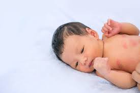 May 25, 2021 · a. Bentol Merah Pada Bayi Gejala Penyebab Dan Cara Mengatasinya Hello Sehat