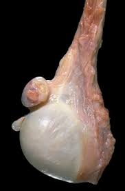 In vertebrates there are two testes; Male Genital Pathology