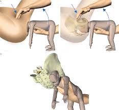 We did not find results for: Vaginal Breech Delivery Chapter 6 Obstetric Interventions