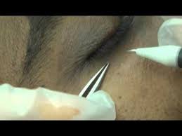 Another approach is to essential choke the skin tag by tying a string around the base to cut off blood supply. Skin Tag Removal From Under Eye Youtube