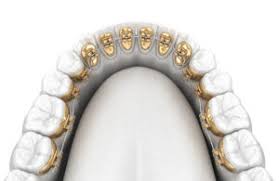 Tips to reduce braces pain. Adult Braces Types Costs Benefits Newmouth