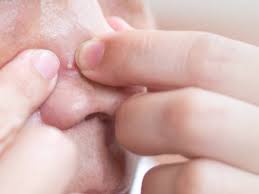 Image result for skin cancer on nose pimple