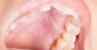 Image result for Oral herpes roof of mouth