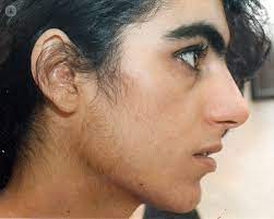 The main difference between typical hair on a woman's body and face (often called peach fuzz) and hair caused by hirsutism is the texture. Hirsutism What Causes Excessive Hair Growth In Women