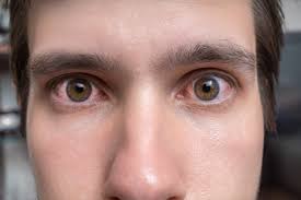 Image result for Allergic Conjunctivitis