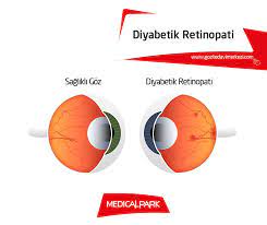 medical park antalya hastane kompleksi goz sagligi ve hastaliklari bolumu nden op dr mehmet tahir sam son zamanlarda sik gorulmeye basla bilgi yuzler gozler