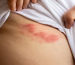 Image result for shingles