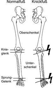 Daher auch die bezeichnung knicksenkfuß. Schmerzen In Den Fussen Und Knien Hackner Fusskompetenz