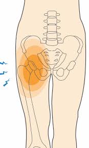 Image result for Hip Labral Tear
