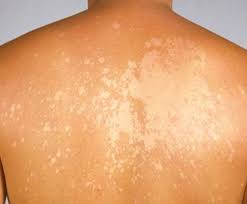 как избавиться от белых пятен на лице в домашних условиях Zhizn Bez Pyaten Skin Spots Herbal Remedies Vitiligo Cure