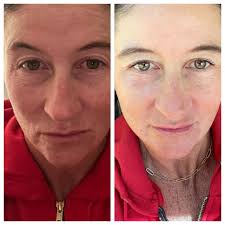 Chronic muscle pain and insomnia after explant surgery?