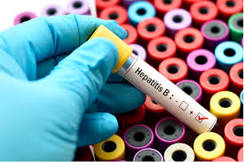 Viral hepatitis is one of the various forms of hepatitis and refers to infections caused by viruses that affect the liver. Hepatitis B Cure A Consideration Of Hbv Abi H0731 Drug