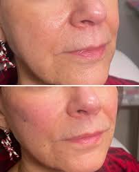 Let's talk about smile lines & volume loss 🤍 As we age, it's not just  about the lines themselves — it's about where volume has been lost. This  client came in concerned