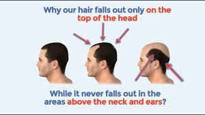 Try this natural treatment on areas of patchy hair loss. Discover The Best And All Natural Stop Hair Loss Treatment