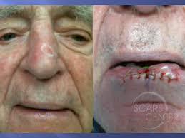 skin cancer occurs when skin cells start growing abnormally, causing cancerous growths. Lower Lip Atypia At Margins Of Squamous Cell Carcinoma Skin Cancer And Reconstructive Surgery Center