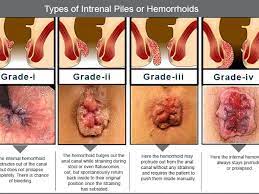 Other factors such as degree of discomfort, bleeding, comorbidities, and patient preference should help. Piles Surgery Lady Doctor In Anantapur