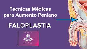 Oct 19, 2017 · overview. Cirurgia De Aumento Peniano Aumento De Penis Faloplastia Youtube