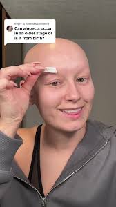 Alopecia Since Birth