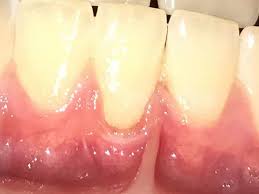 A loose tooth due to trauma can tighten back up: Do Receding Gums Grow Back Treatments And Prevention